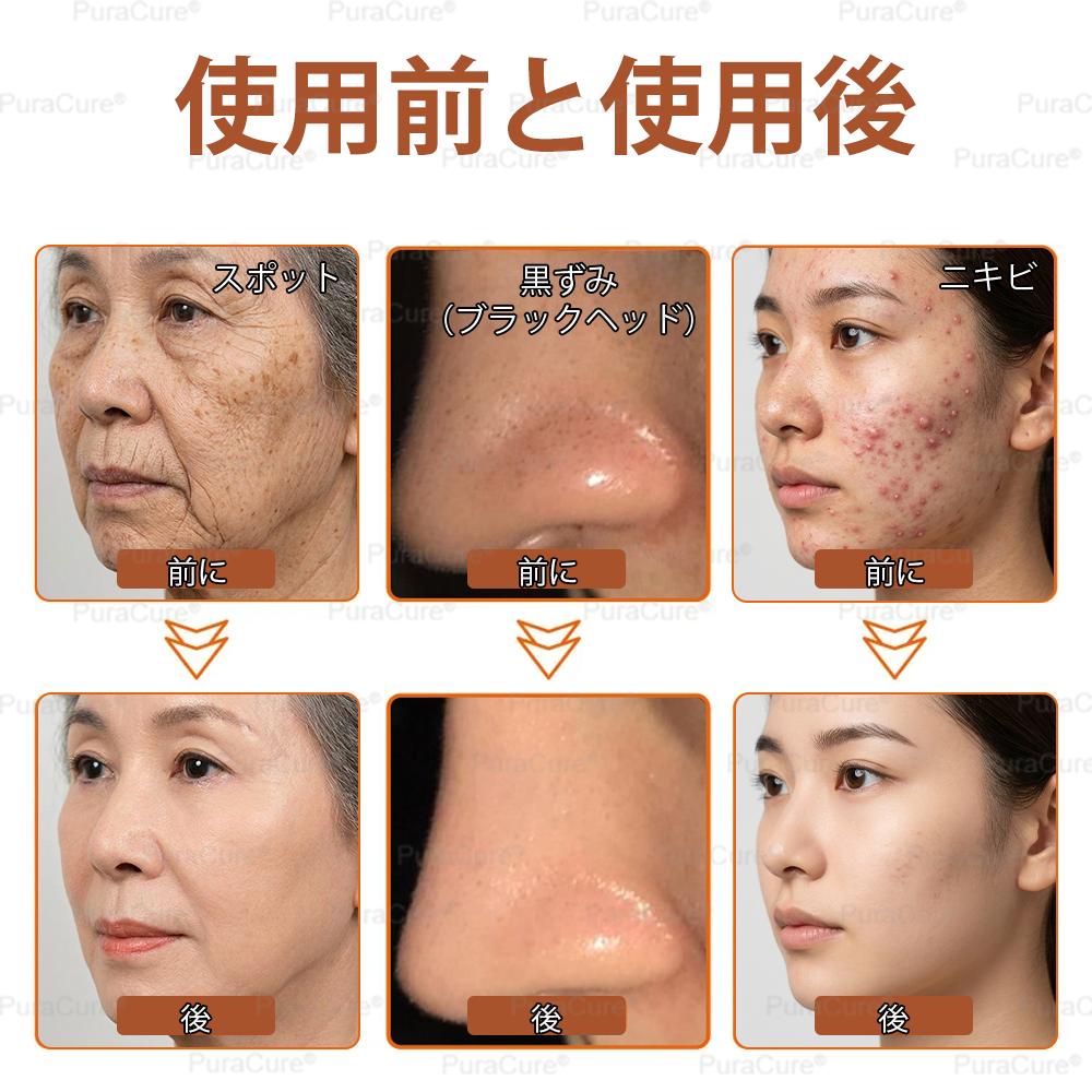 🏵️PuraCure® 美白・スポットケアフェイスマスク【顔・ボディ兼用】天然由来成分配合で、シミ・そばかす・日焼けによるシミを長期間ケア✨